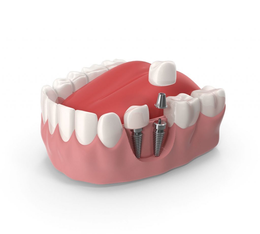 Dental implant illustration showing how Crystal Dental Care replaces missing teeth
