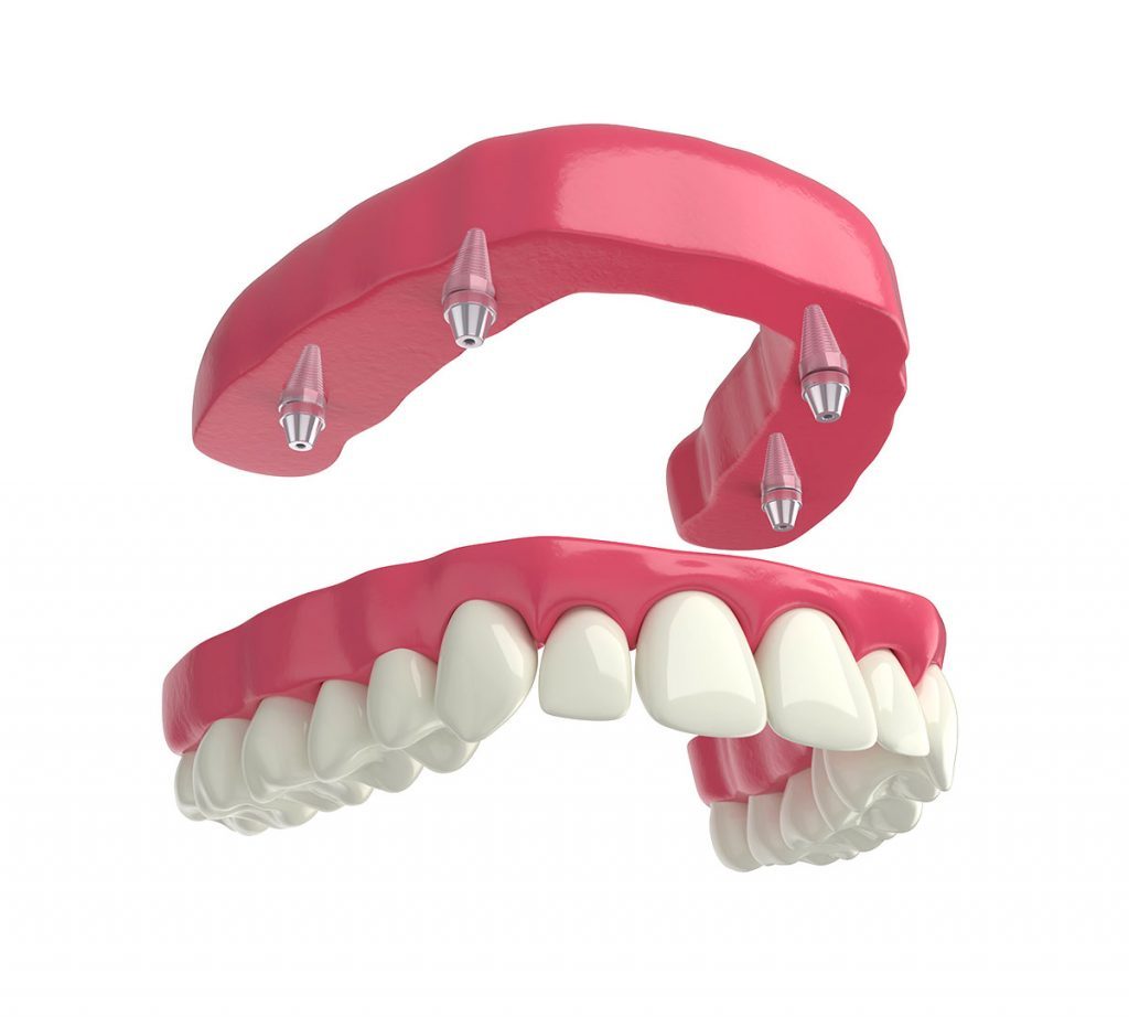 Full-mouth reconstruction with implant-supported teeth at Crystal Dental Care