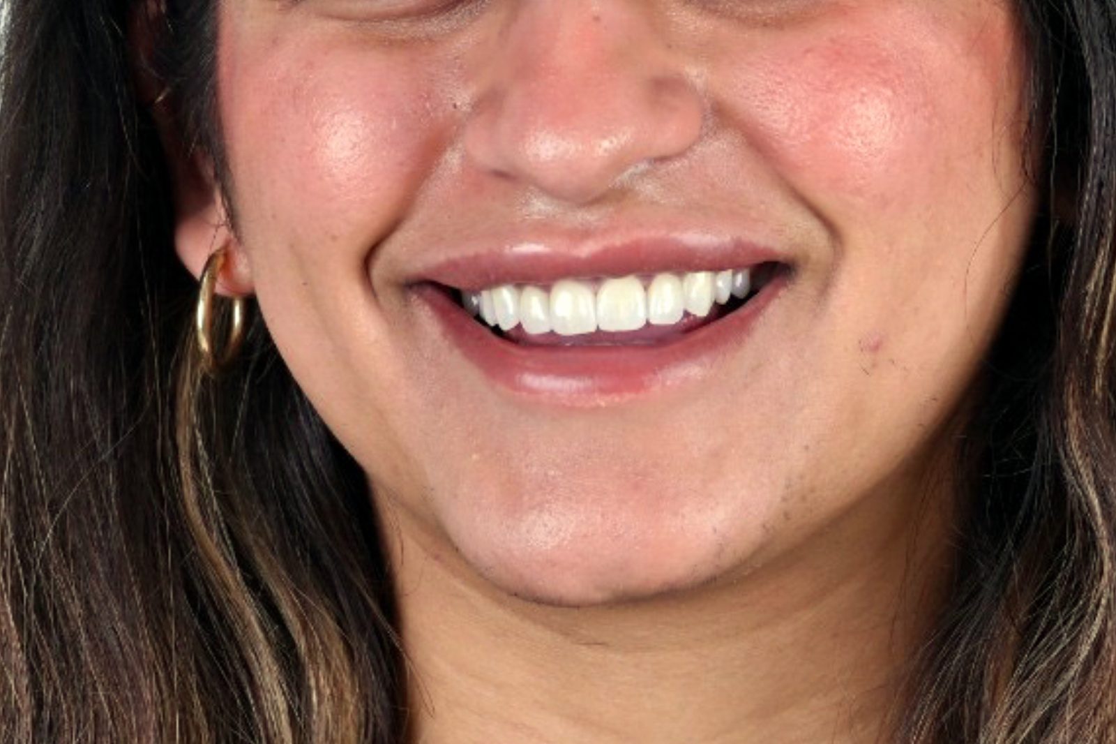 Patient's bright new smile after treatment at Crystal Dental Care in Jacó