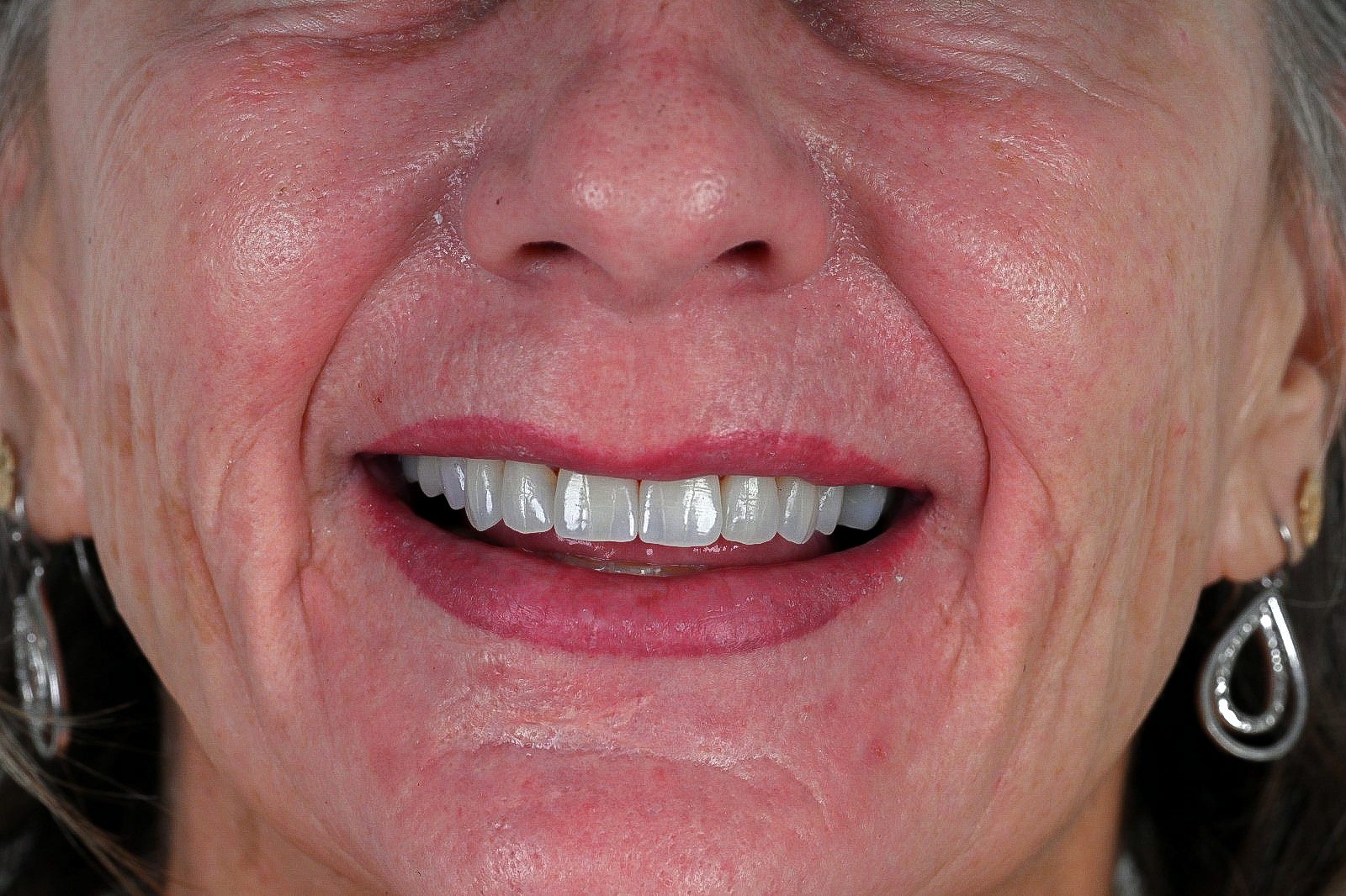 Beautiful restored smile after a smile makeover at Crystal Dental Care